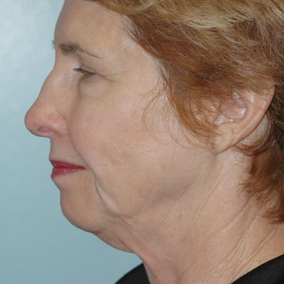 Ponytail Facelift before and after, case 51, view 4 (before)
