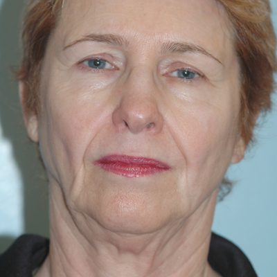 Ponytail Facelift before and after, case 51, view 5 (before)