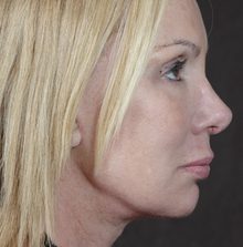Ponytail Facelift before and after, case 52 (after)
