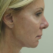 Ponytail Facelift before and after, case 52 (before)