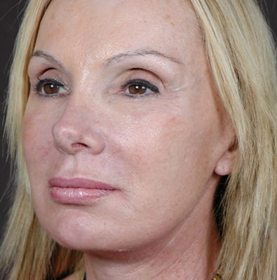 Ponytail Facelift before and after, case 52, view 3 (after)