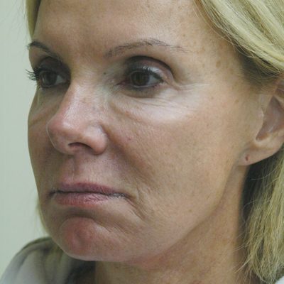 Ponytail Facelift before and after, case 52, view 3 (before)