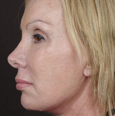 Ponytail Facelift before and after, case 52, view 4 (after)
