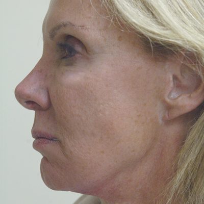Ponytail Facelift before and after, case 52, view 4 (before)