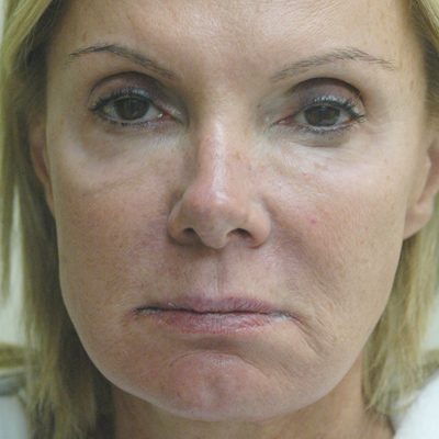 Ponytail Facelift before and after, case 52, view 5 (before)