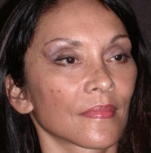 Ponytail Facelift before and after, case 53 (after)