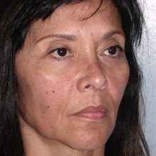 Ponytail Facelift before and after, case 53 (before)