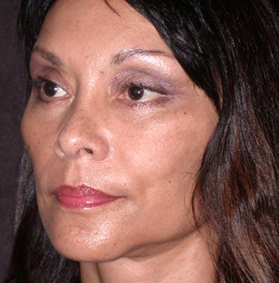 Ponytail Facelift before and after, case 53, view 3 (after)