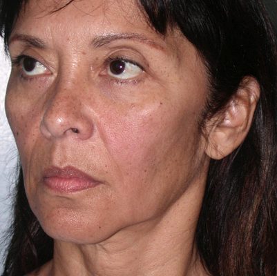 Ponytail Facelift before and after, case 53, view 3 (before)