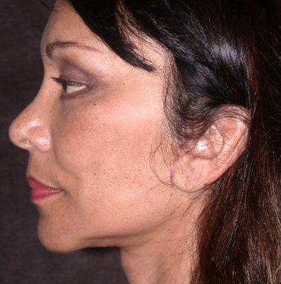 Ponytail Facelift before and after, case 53, view 4 (after)