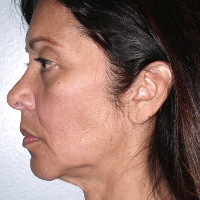 Ponytail Facelift before and after, case 53, view 4 (before)