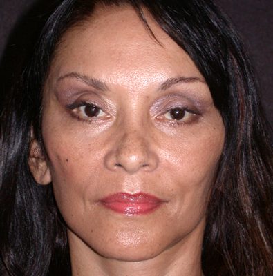 Ponytail Facelift before and after, case 53, view 5 (after)