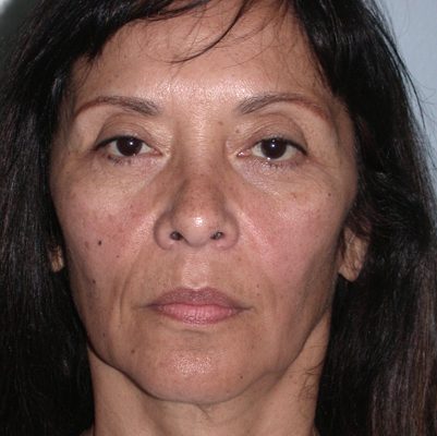 Ponytail Facelift before and after, case 53, view 5 (before)