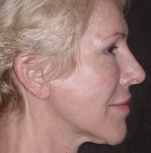 Ponytail Facelift before and after, case 54 (after)
