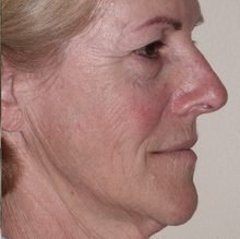 Ponytail Facelift before and after, case 54 (before)
