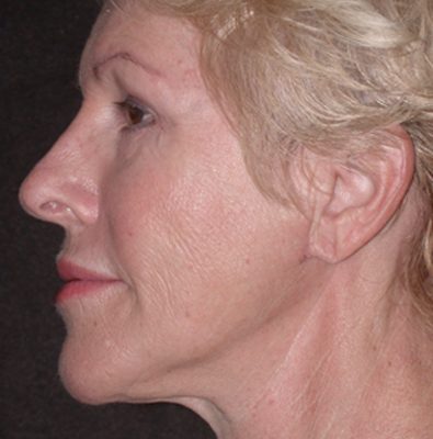 Ponytail Facelift before and after, case 54, view 3 (after)