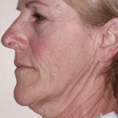 Ponytail Facelift before and after, case 54, view 3 (before)