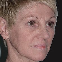 Ponytail Facelift before and after, case 55 (before)