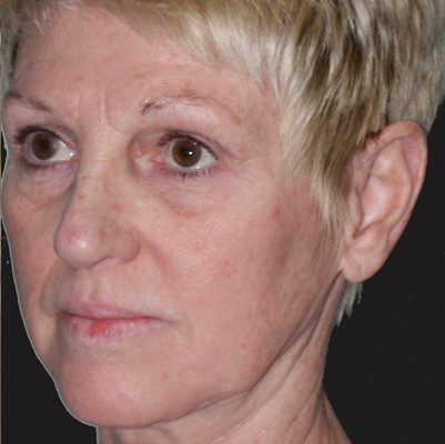 Ponytail Facelift before and after, case 55, view 3 (before)