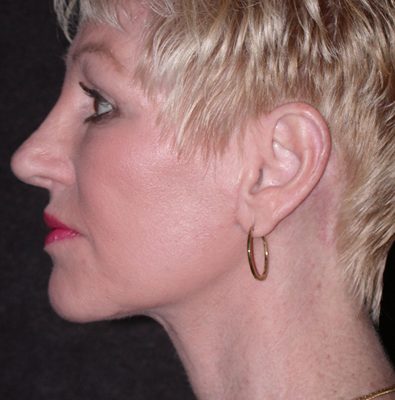 Ponytail Facelift before and after, case 55, view 4 (after)