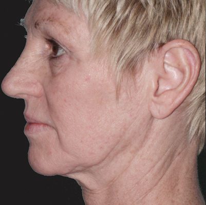 Ponytail Facelift before and after, case 55, view 4 (before)