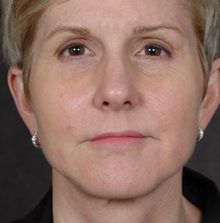 Ponytail Facelift before and after, case 56 (after)