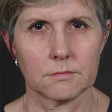 Ponytail Facelift before and after, case 56 (before)