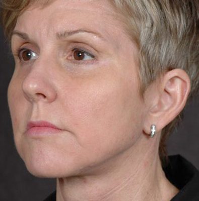 Ponytail Facelift before and after, case 56, view 3 (after)