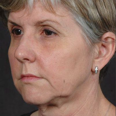 Ponytail Facelift before and after, case 56, view 3 (before)