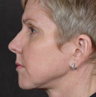 Ponytail Facelift before and after, case 56, view 4 (after)