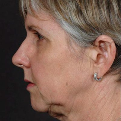Ponytail Facelift before and after, case 56, view 4 (before)