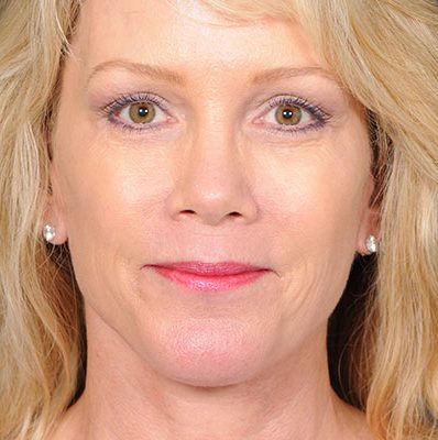 Ponytail Facelift before and after, case 57, view 3 (after)