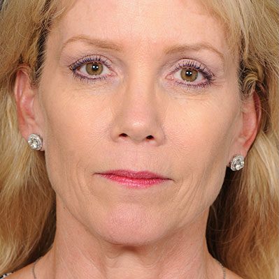 Ponytail Facelift before and after, case 57, view 3 (before)