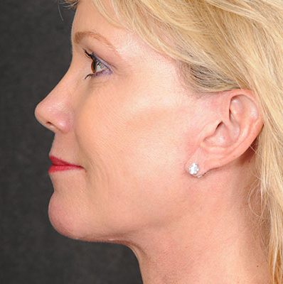 Ponytail Facelift before and after, case 57, view 4 (after)