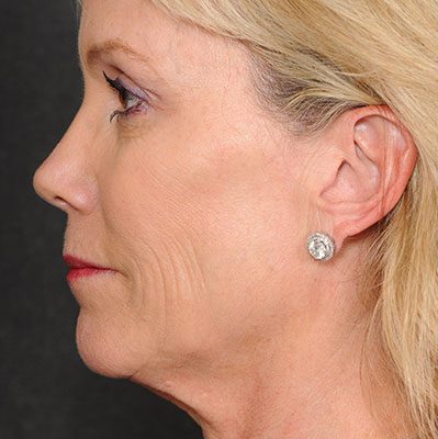 Ponytail Facelift before and after, case 57, view 4 (before)