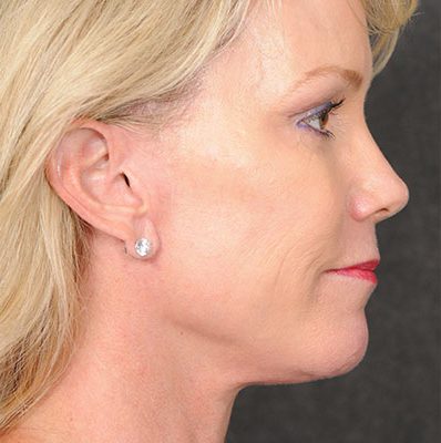 Ponytail Facelift before and after, case 57, view 5 (after)