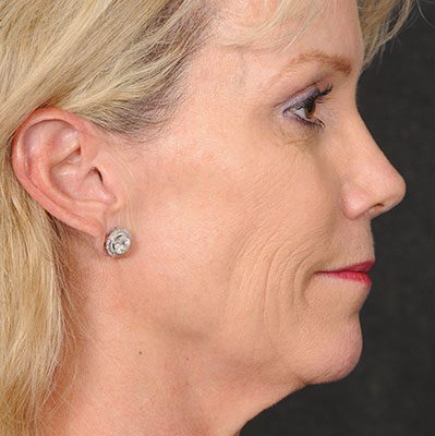 Ponytail Facelift before and after, case 57, view 5 (before)