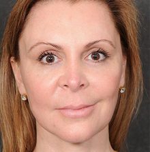 Ponytail Facelift before and after, case 58 (after)