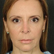 Ponytail Facelift before and after, case 58 (before)
