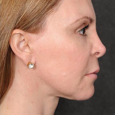 Ponytail Facelift before and after, case 58, view 3 (after)