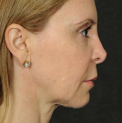 Ponytail Facelift before and after, case 58, view 3 (before)