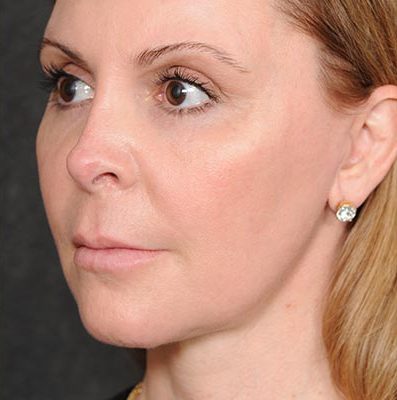 Ponytail Facelift before and after, case 58, view 4 (after)