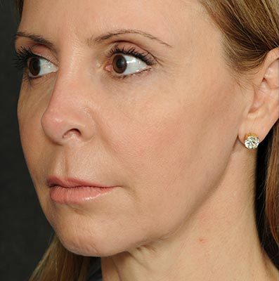 Ponytail Facelift before and after, case 58, view 4 (before)
