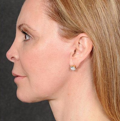 Ponytail Facelift before and after, case 58, view 5 (after)