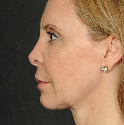 Ponytail Facelift before and after, case 58, view 5 (before)
