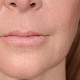Ponytail Facelift before and after, case 58, view 6 (after)