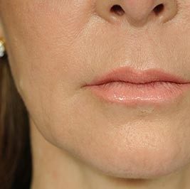 Ponytail Facelift before and after, case 58, view 6 (before)