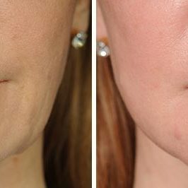 Ponytail Facelift before and after, case 58, view 6 (progress)