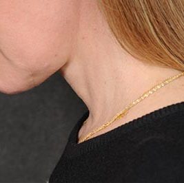 Ponytail Facelift before and after, case 58, view 7 (after)