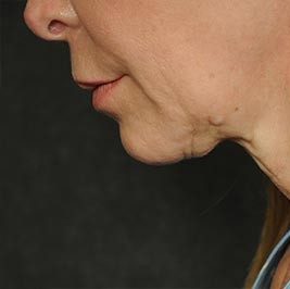 Ponytail Facelift before and after, case 58, view 7 (before)